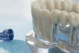 Clinica odontoiatrica in Albania e l’implantologia dentale